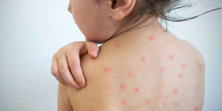 OMS alerta por aumento alarmante de casos de sarampión en Europa
