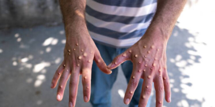 Nueva variante de Mpox en Asia lleva a Singapur a aumentar medidas de prevención
